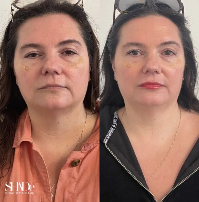 Microneedling with BioRePeel Before and After Photo by Sherisse Hill Aesthetic Derm SHADe in Issaquah WA x