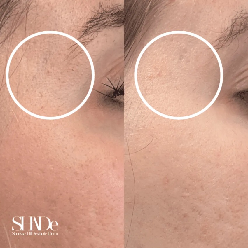 Microneedling with BioRePeel Before and After Photo by Sherisse Hill Aesthetic Derm SHADe in Issaquah WA x
