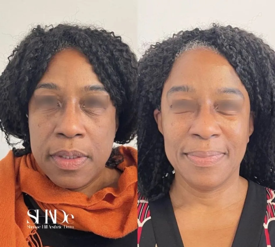 Global Facial Harmonization Microneedling with BioRePeel Before and After Photo by Sherisse Hill Aesthetic Derm SHADe in Issaquah WA x